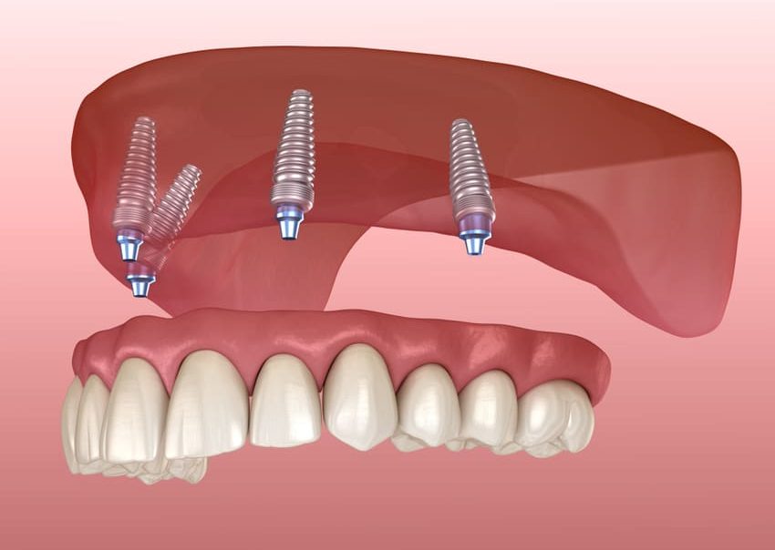 Prótesis sobre implantes - Tecnica All on 4 y All on 6