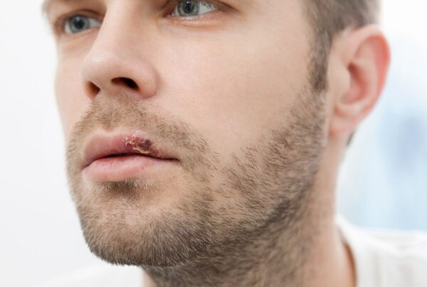 Herpes labial