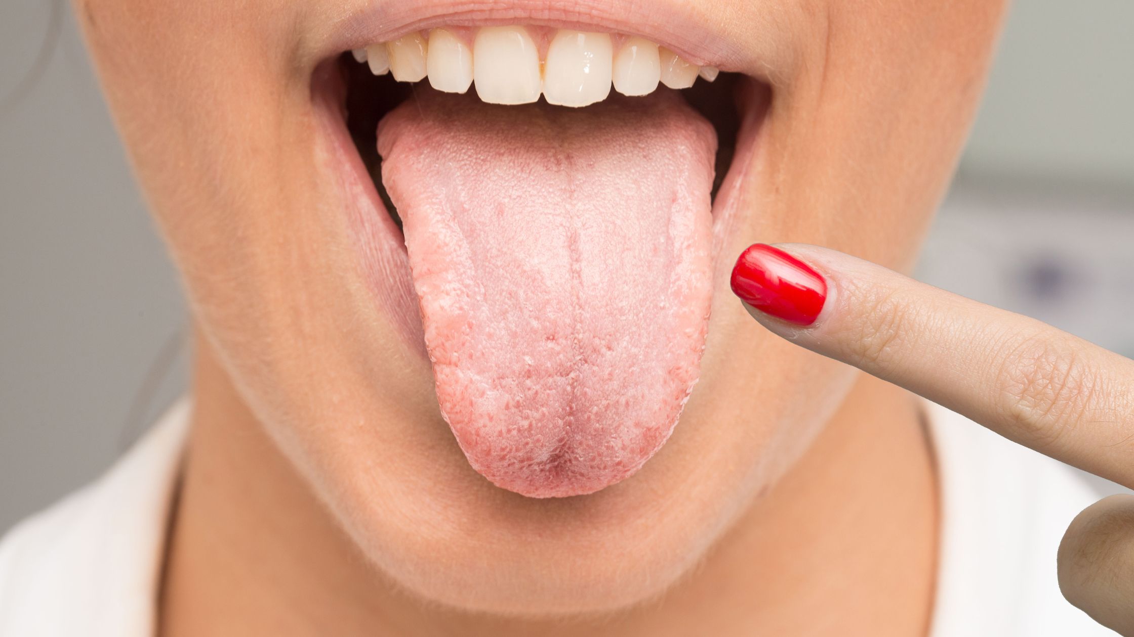 candidiasis oral
