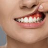 Clínica Dental en Las Palmas | Dr. Román Hernández | Absceso dental (flemón): cómo reconocerlo y por qué no esperar absceso dental