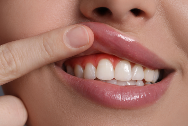 bolsas periodontales